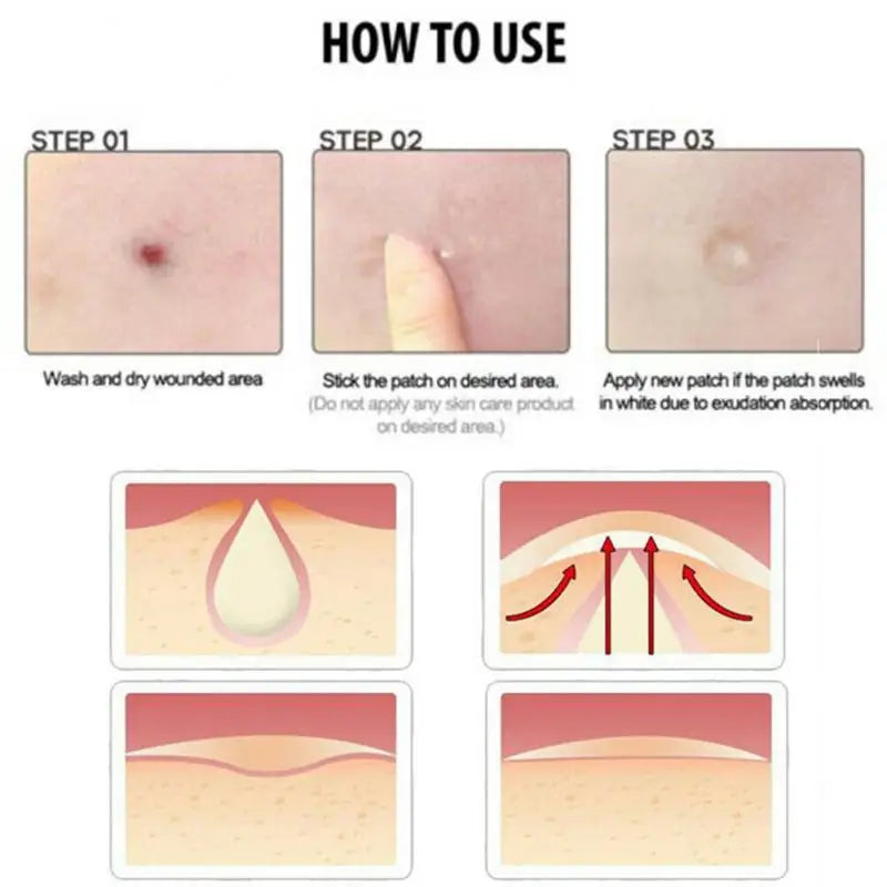 36pcs Remover Pimple Master Patch Acne Treatment Protects Invisible Acne Patch Face Care Cosmetics Face Skin Care Tools